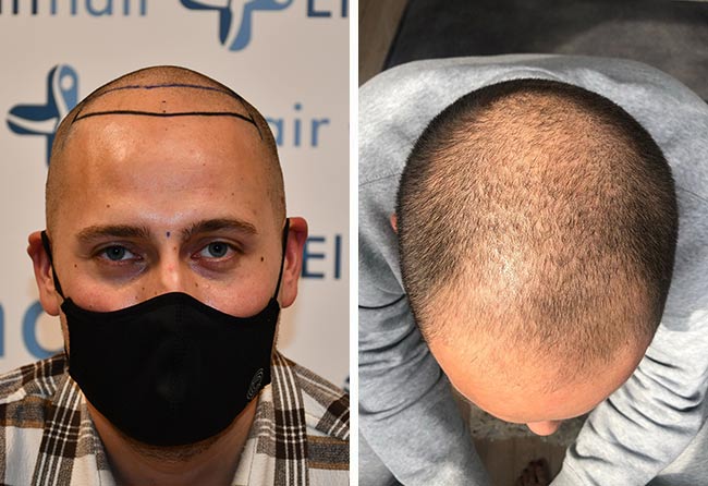Monier Achahbar vor der DHI Haartransplantation mit 4000 Grafts