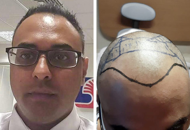 Patient Shahid Ahmad vor der DHI Haartransplantation mit 4000 Grafts