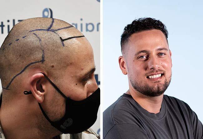 Monier Achahbar Vorher Nachher DHI Haartransplantation mit 4000 Grafts