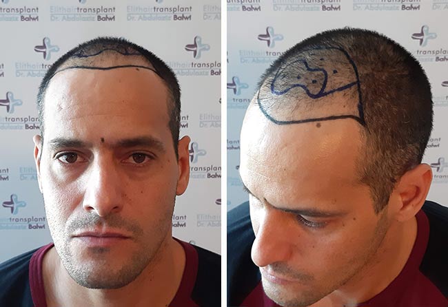 Rawderson A Saphir Haartransplantation 3500 Grafts Vorher