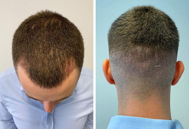 Cilian W 4 Wochen nach der DHI Haartransplantation mit 3140 Grafts