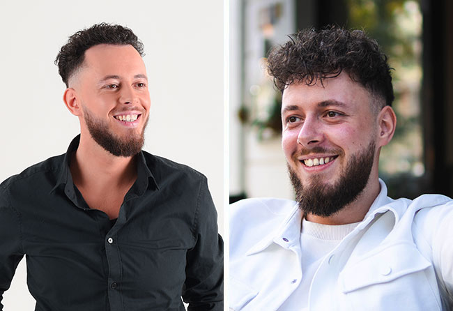 Cilian W Ergebnis der DHI Haartransplantation mit 3140 Grafts