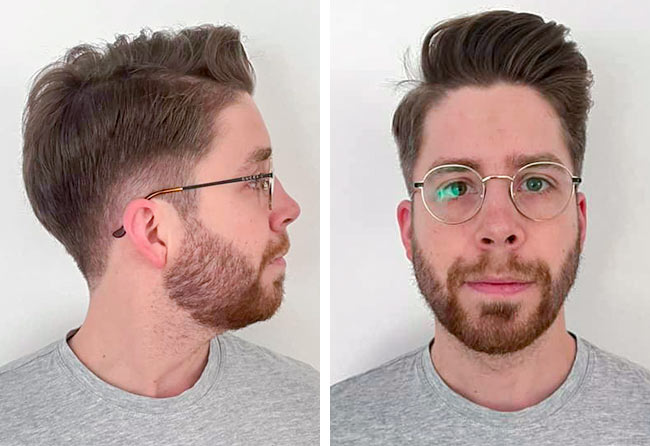 Nachher Saphir Barttransplantation mit 3200 Grafts bei Patient Eike R.