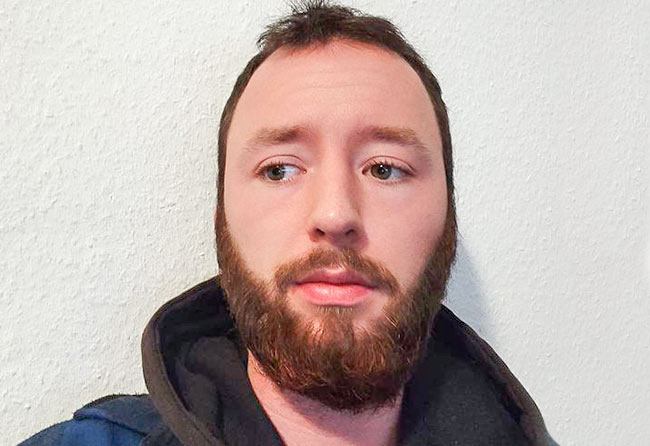 Nachher Saphir Barttransplantation mit 3700 Grafts bei Patient Felix V.