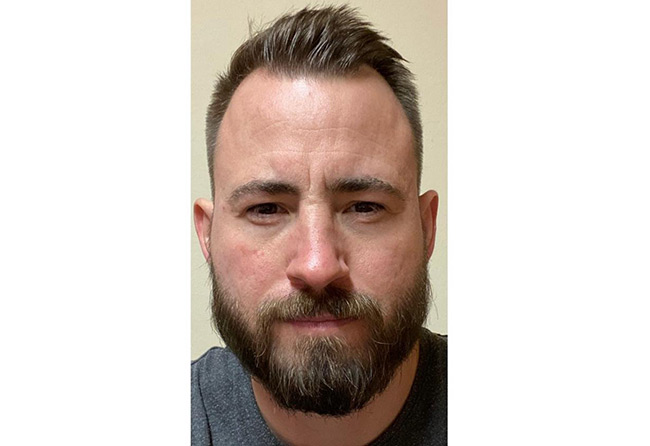 Nachher Saphir Barttransplantation mit 4200 Grafts bei Patient Steven A.