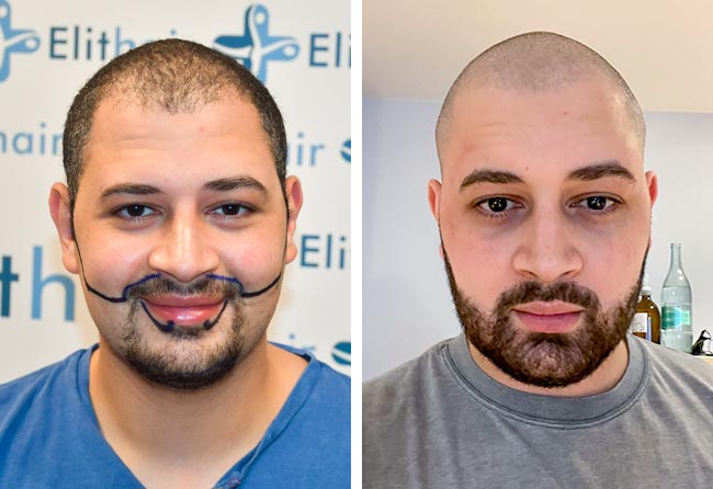 Vorher nachher Saphir Barttransplantation mit 3750 Grafts bei Patient Mohammed E.