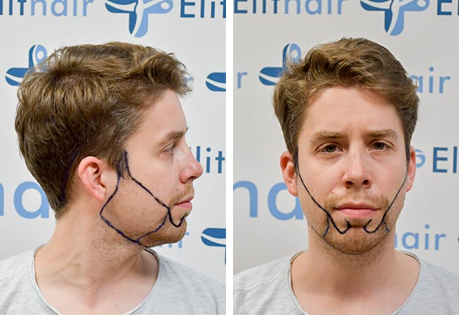 Vorher Saphir Barttransplantation mit 3200 Grafts bei Patient Eike R.