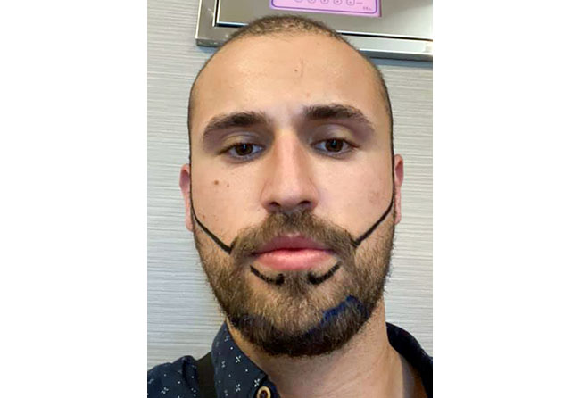 Vorher Saphir Barttransplantation mit 3300 Grafts bei Patient Hu Le