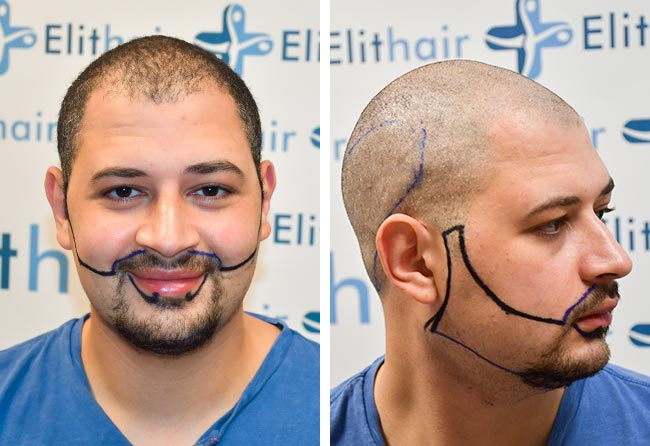 Vorher Saphir Barttransplantation mit 3750 Grafts bei Patient Mohammed E.