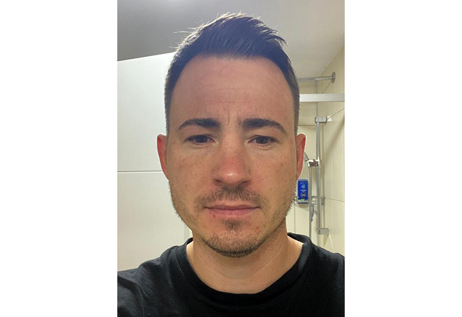 Vorher Saphir Barttransplantation mit 4200 Grafts bei Patient Steven A.