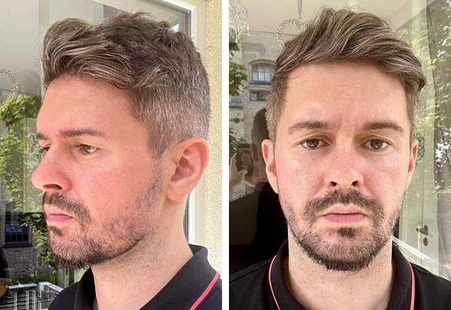 Vorher Saphir Barttransplantation mit 4250 Grafts bei Patient Ismar S.