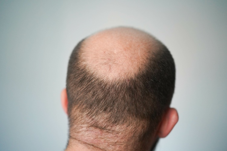 Hinterkopf eines Mannes mit einer Tonsur