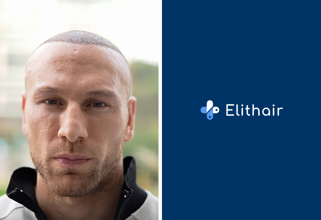 Kerim Engizek 1 Tag nach seiner Haartransplantation