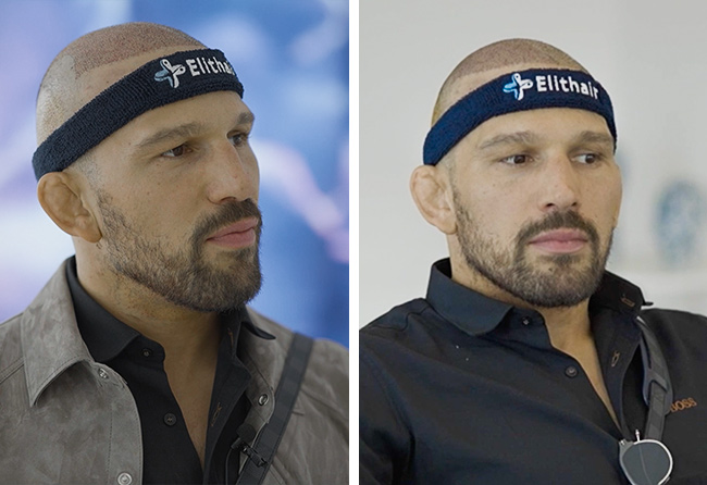 Max Coga einen Tag nach seiner DHI Haartransplantation mit 3250 Grafts