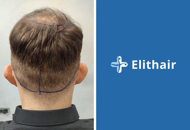 Spenderbereich vor Haartransplantation &ndash; Max C., 3.250 Grafts