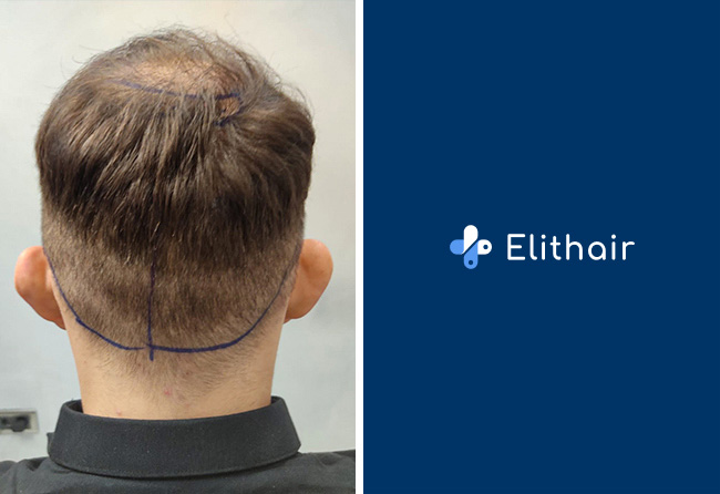Spenderbereich Max Coga vor der Haartransplantation mit 3250 Grafts