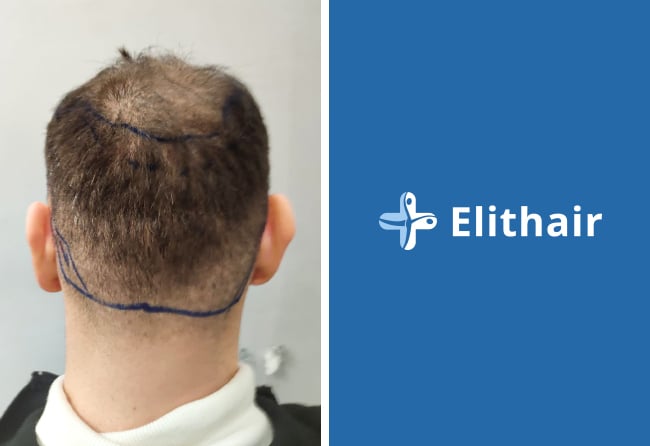 Spenderbereich vor Haartransplantation &ndash; Kerim E., 4.000 Grafts