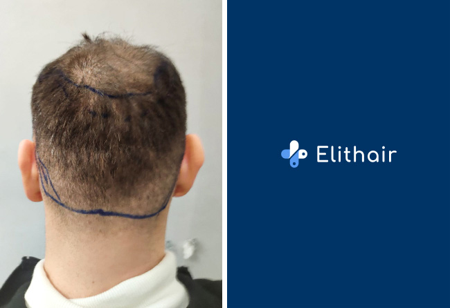 Der Spenderbereich von Kerim Engizek vor der Haartransplantation