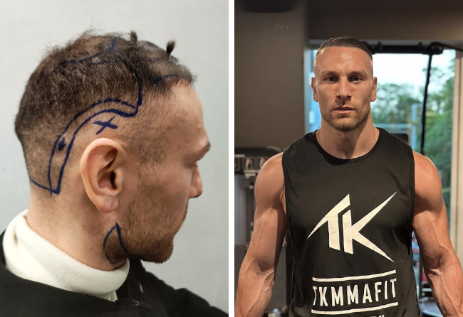 Kerim Engizek vor und nach seiner Haartransplantation