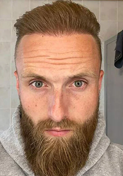 Patient zeigt seine vollen Haare nach der Haartransplantation