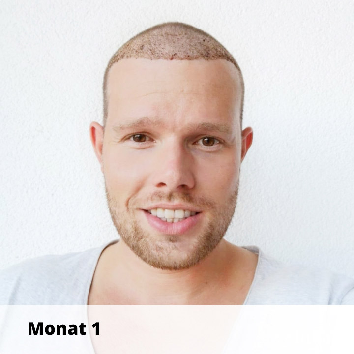 Elithair Patient zeigt seine Haartransplantation Heilung nach 1 Monat