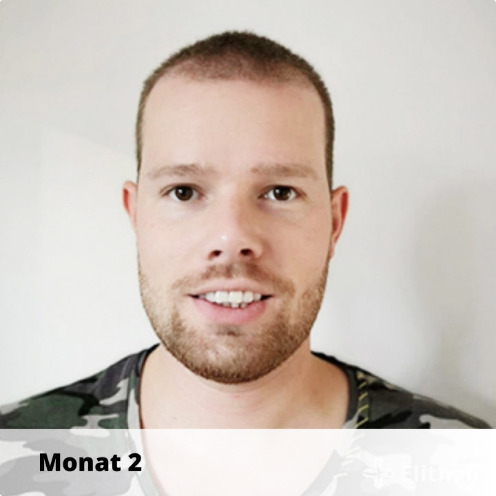 Elithair Patient zeigt seine Haartransplantation Heilung nach 2 Monaten