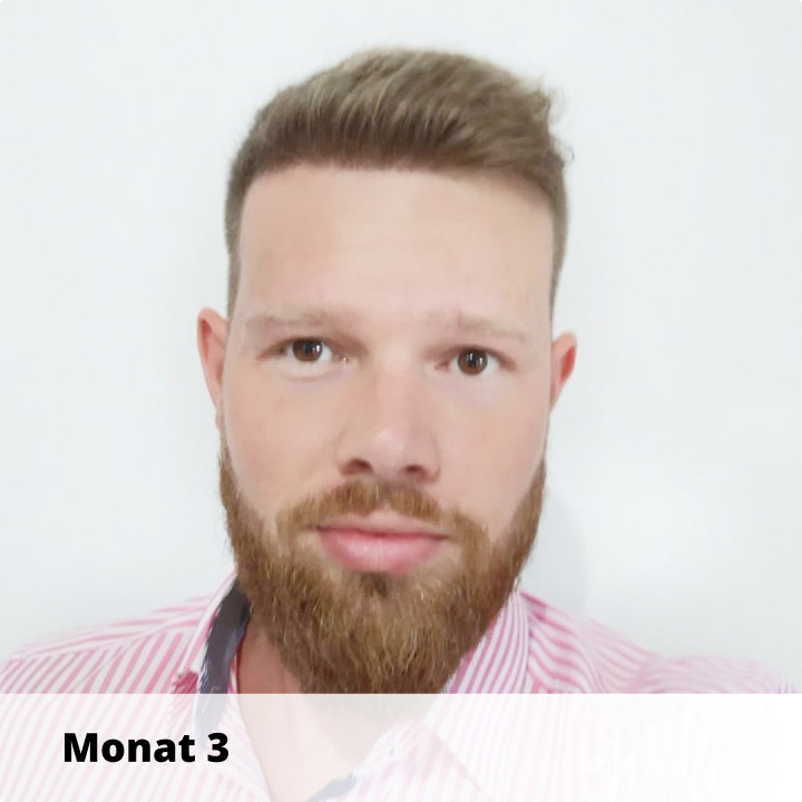 Elithair Patient zeigt seine Haartransplantation Heilung nach 3 Monaten