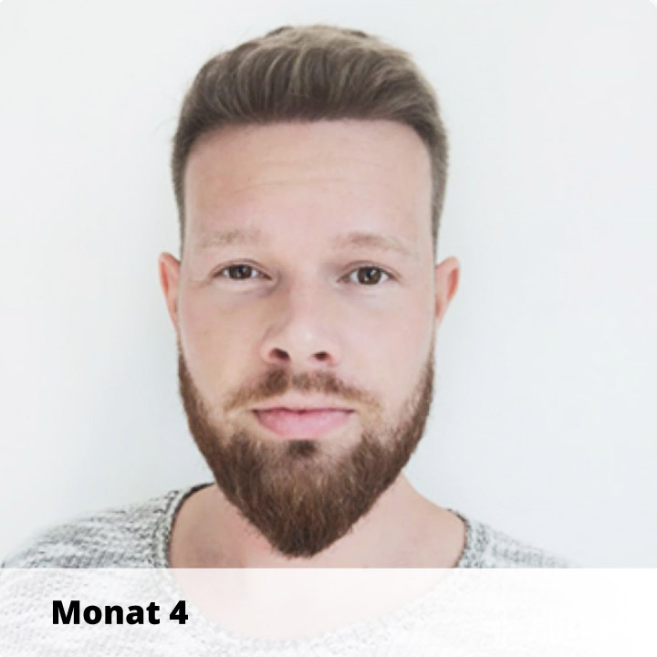 Elithair Patient zeigt seine Haartransplantation Heilung nach 4 Monaten