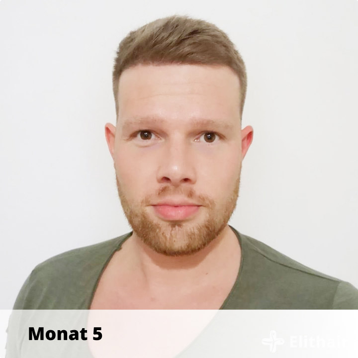 Elithair Patient zeigt seine Haartransplantation Heilung nach 5 Monaten