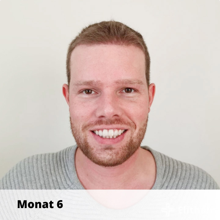 Elithair Patient zeigt seine Haartransplantation Heilung nach 6 Monaten