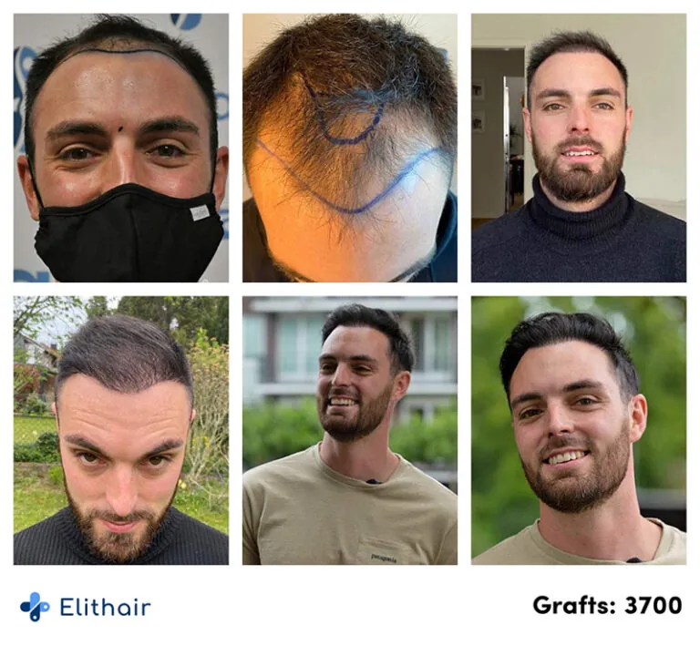 Elithair Patient zeigt seinen Vorher Nachher Verlauf mit der DHI Haartransplantation mit der Verpflanzung von 3700 Grafts