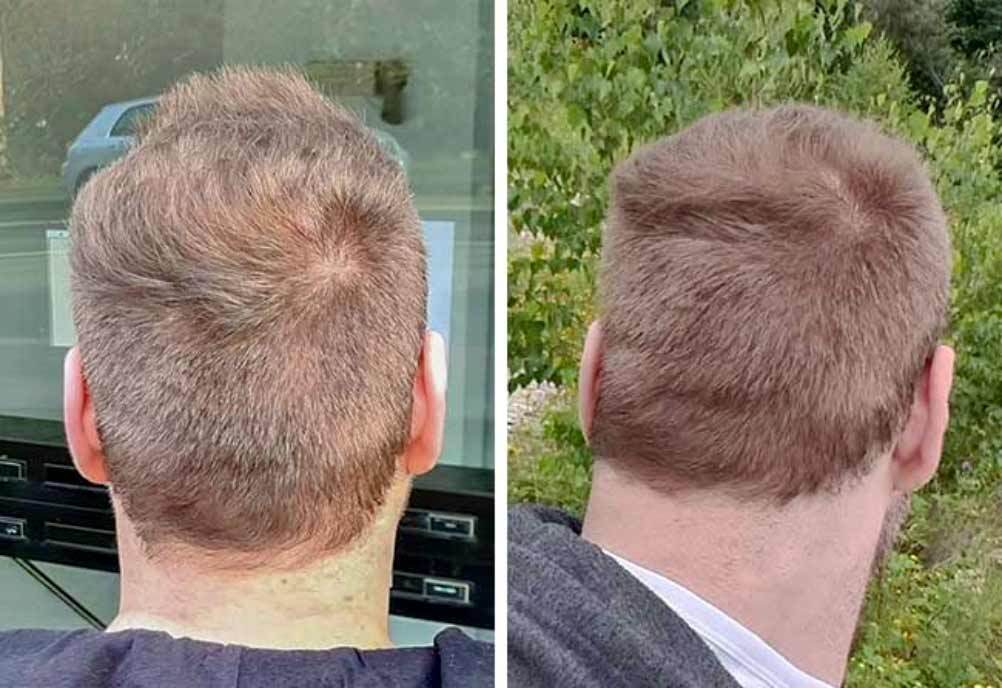 Elithair Patient zeigt seinen Spenderbereich nach seiner Haartransplantation