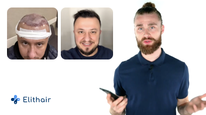 Thumbnail Haartransplantation Heilung Prozess beim Patienten