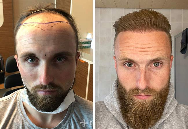 Vorher-Nachher Vergleichsbilder von Elithair Patient Frederic