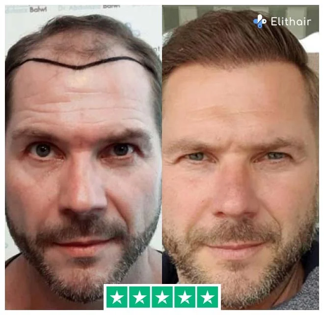 Das Bild zeigt Marcus, einen Elithair-Patienten, vor und nach seiner Haartransplantation mit 4100 Grafts