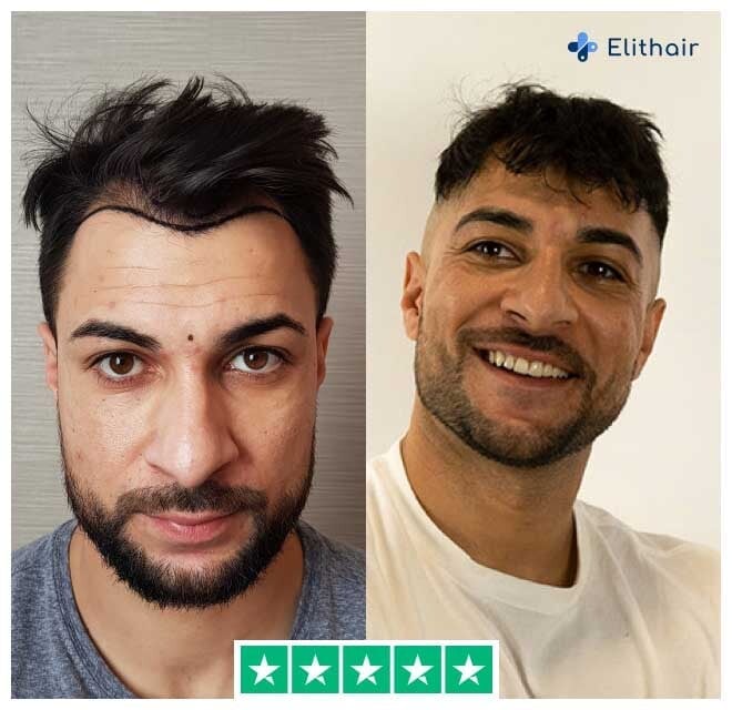 Das Bild zeigt Osmani, einen Elithair-Patienten, vor und nach seiner Haartransplantation mit 2200 Grafts