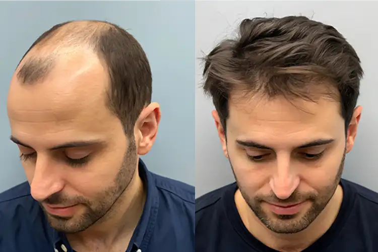 Ein Mann zeigt das Vorher-Nachher-Ergebnis einer Haartransplantation