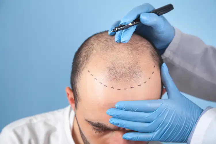 Bei der Planung einer Haartransplantation werden die optimalen Stellen eingezeichnet