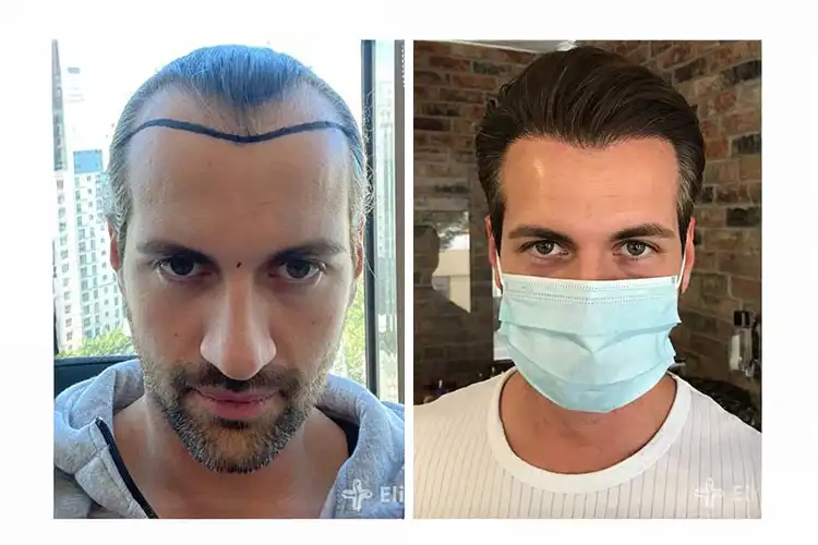 Vorher-Nachher-Vergleich eines Elithair-Patienten nach der Haartransplantation – deutlich sichtbar dichterer Haaransatz.