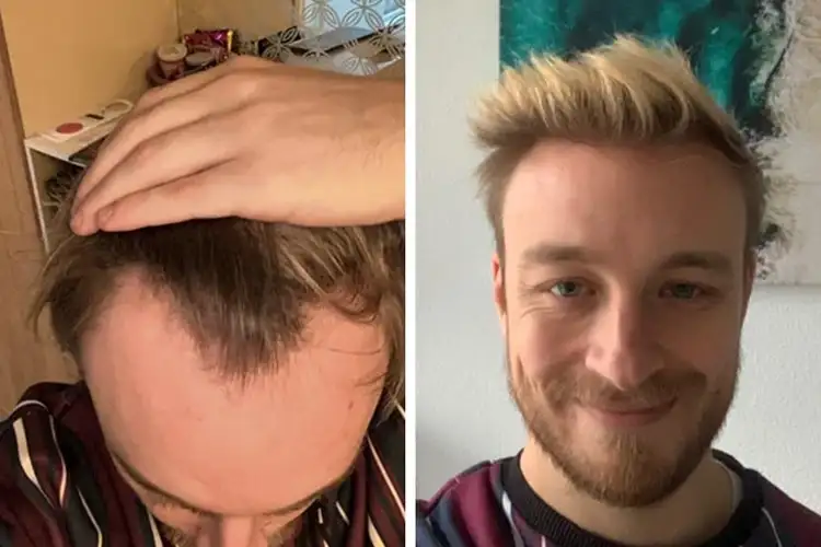 Vorher-Nachher-Bild von Elithair-Patient Marius S. nach einer Haartransplantation