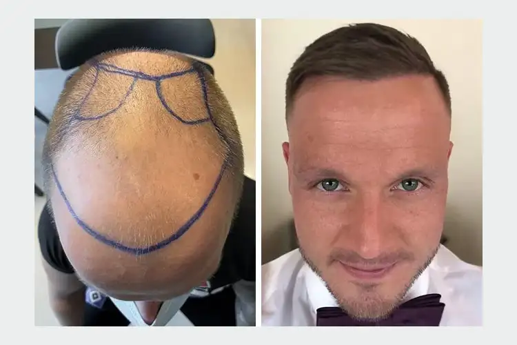 Vorher-Nachher-Bild von Elithair-Patienten Dominik K. nach einer erfolgreichen Haartransplantation