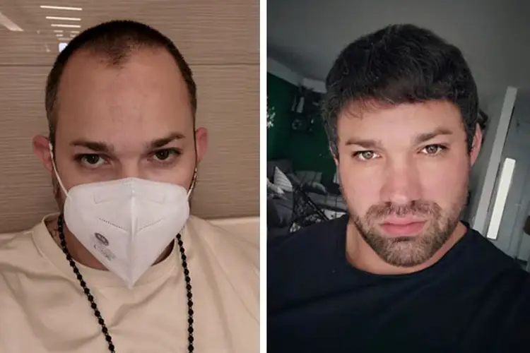 Vorher-nachher-Bild von Elithair-Patient Manuel A. nach erfolgreicher Haartransplantation – deutlich sichtbare Verdichtung und natürliche Haarlinie