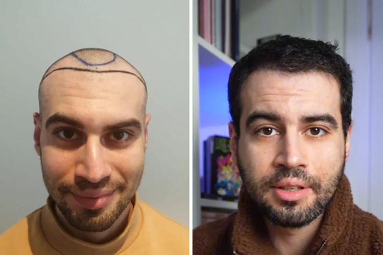 Vorher-Nachher-Bild von Elithair-Patient Spybas nach einer Haartransplantation