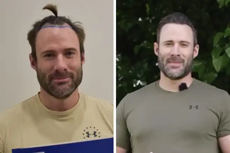 Vorher-Nachher-Bild von Otto Bulletproof nach einer Haartransplantation bei Elithair