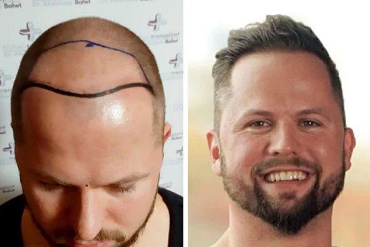 Vorher-Nachher-Bild von Elithair-Patient Nico G. nach einer Haartransplantation