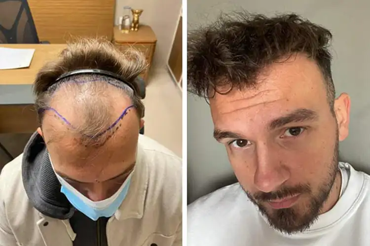 Vorher-Nachher-Bild eines Elithair-Patienten mit dichterem Haaransatz – sichtbare Veränderung.
