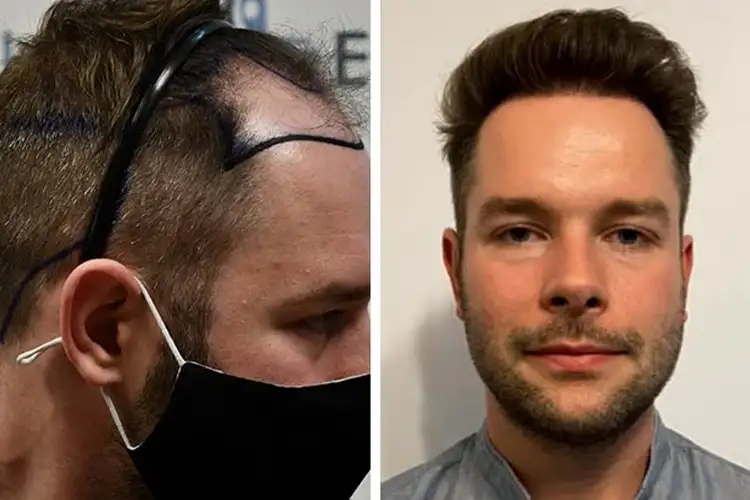 Vorher-Nachher-Bild von Elithair-Patient Michael S. nach einer Haartransplantation