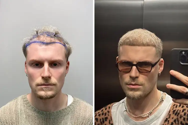 Vorher-Nachher-Bild von Elithair-Patient Tom Cordes nach einer Haartransplantation