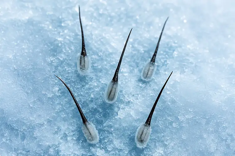 Nahaufnahme von tiefgefrorenen Haarfollikeln, eingebettet in eine Eisschicht – stellvertretend für die Ice Graft Methode mit starker Unterkühlung