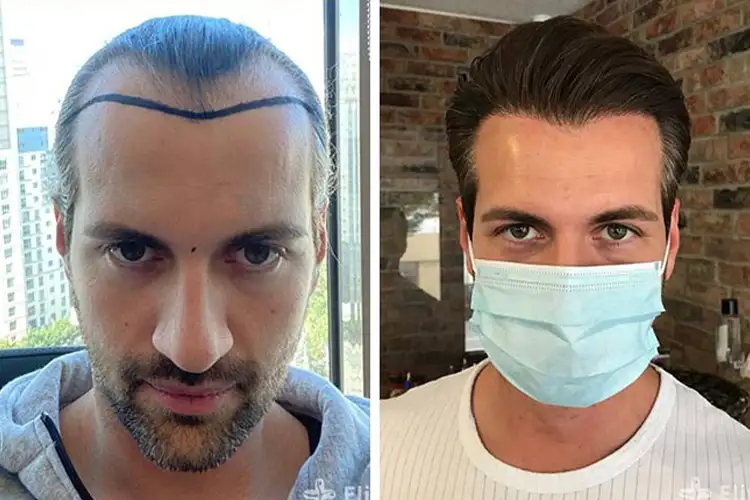 Elithair-Patient Cagatay nach der Haartransplantation – sichtbar dichteres, natürlich wirkendes Haar als Ergebnis der Behandlung
